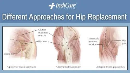 Different Approaches for Hip Replacement Different Approaches for Hip Replacement